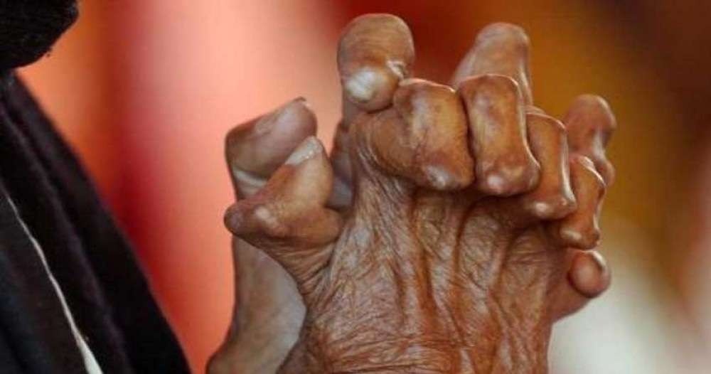 कुष्ठरोग प्रभावितसँग सम्बन्धित नीति तथा कानुन पुनरावलोकन गर्न सुझाव